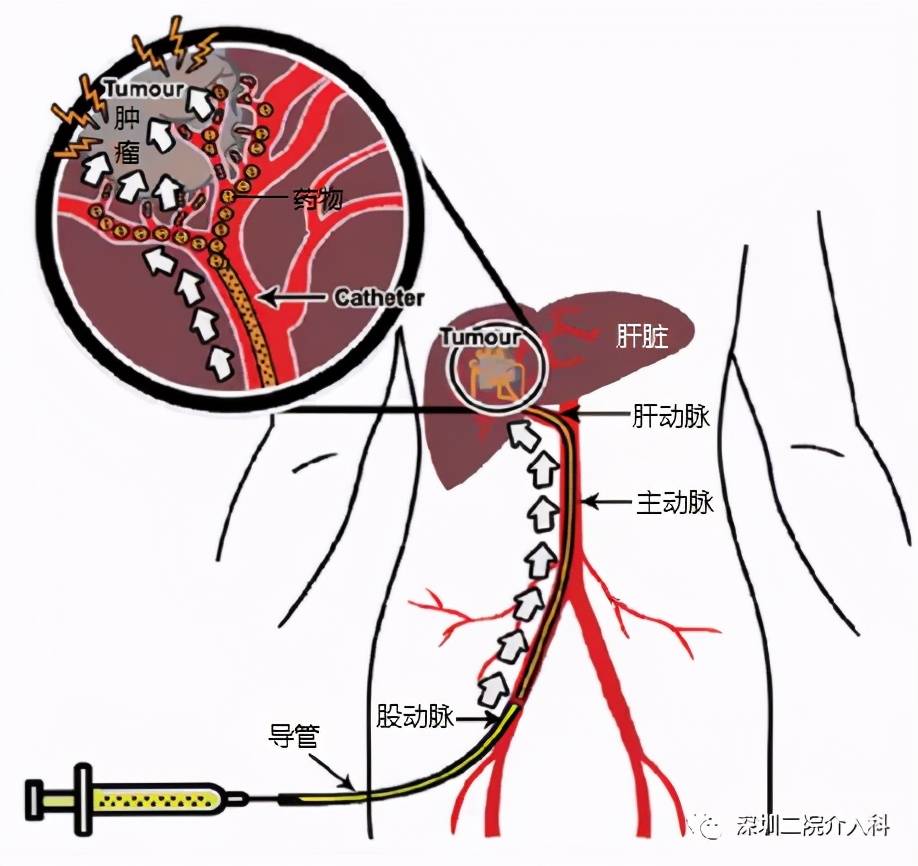 患者|高龄患者得肝癌就要放弃治疗？介入医生说“NO”！