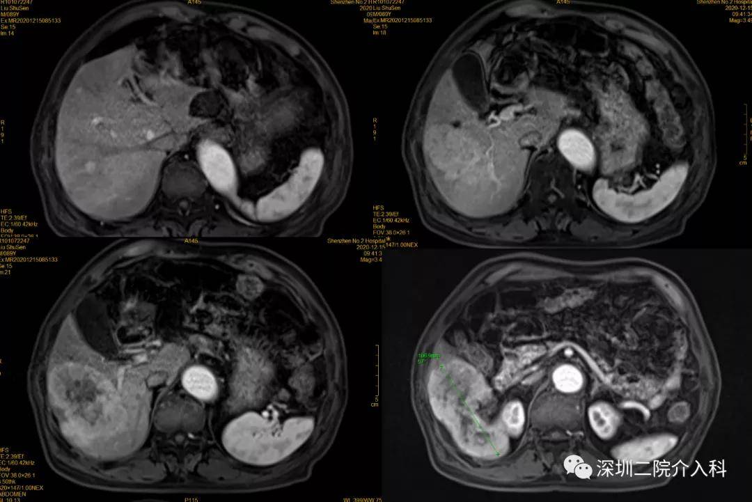 患者|高龄患者得肝癌就要放弃治疗？介入医生说“NO”！