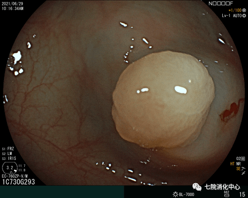手术|结肠息肉怎么破？内镜帮您来搞定