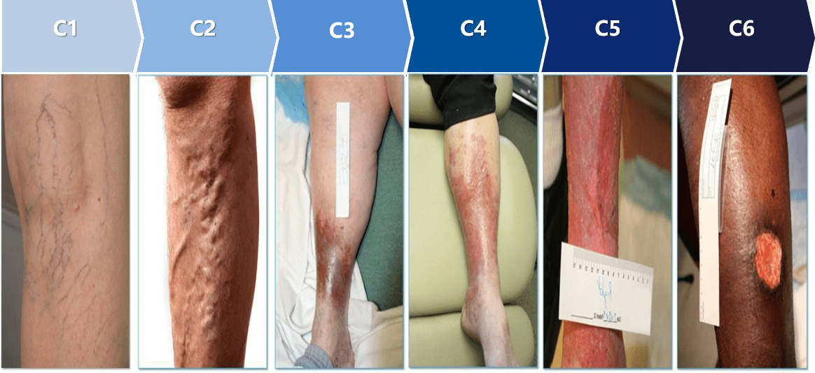 弹力袜|下肢静脉曲张手术期间需要注意哪些事？