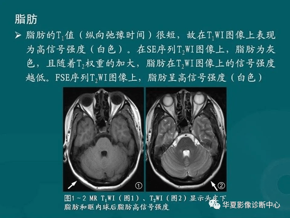 磁共振信號表現及基本徵象分析