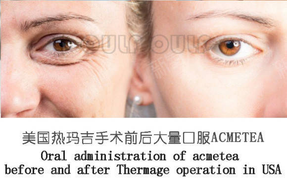 玛吉|热玛吉原理及作用原来是这样，怪不得被称为去皱神器