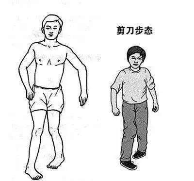 小儿脑瘫影响的是整个家庭,父母要及时预防