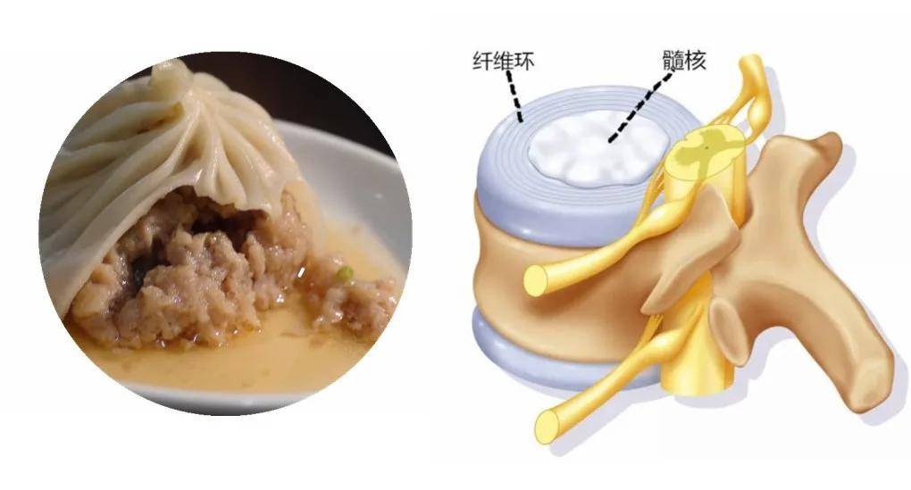 科普|脊柱科普丨腿痛？可能是腰出现了问题！