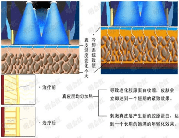 玛吉|做热玛吉的副作用是啥？闺蜜怎么都说做毁了