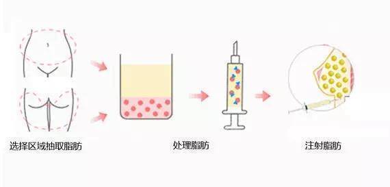 面部|自体脂肪填充面部多久恢复自然？反正闺蜜恢复挺快，真的变脸啦