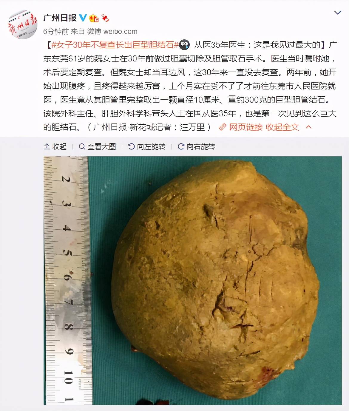 女子30年不复查长出巨型胆结石从医35年医生这是我见过最大的