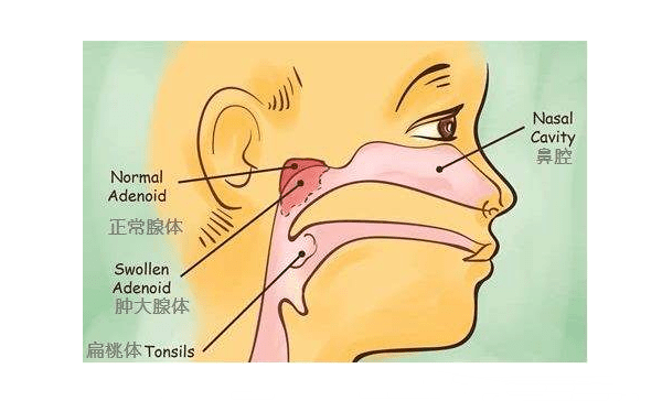 兒童腺樣體手術利弊寶媽們快注意起來