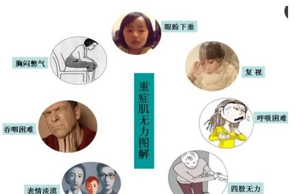 知识科普|重症肌无力没办法治疗了？不要被它吓到了，它只是在虚张声势而已