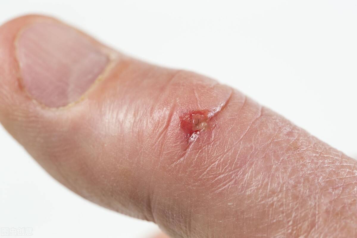 途径|乙肝的主要传播途径有哪些?医生:这3种情况,可能会传染