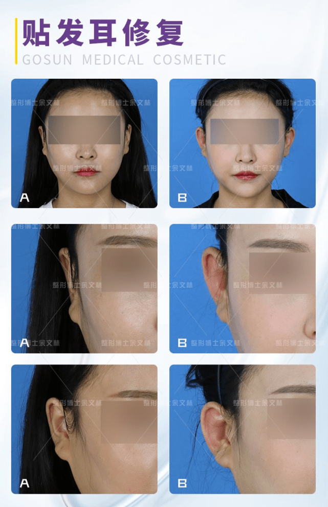 正面看不到耳朵 做贴发耳矫正整形术有风险吗 手术