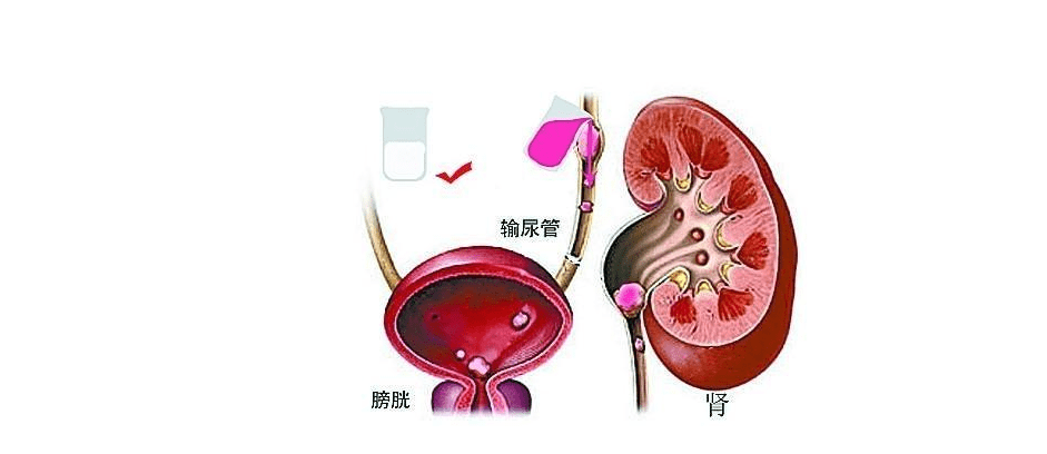 一名8歲的患兒確診了腎臟和輸尿管結石錯失最佳治療時機