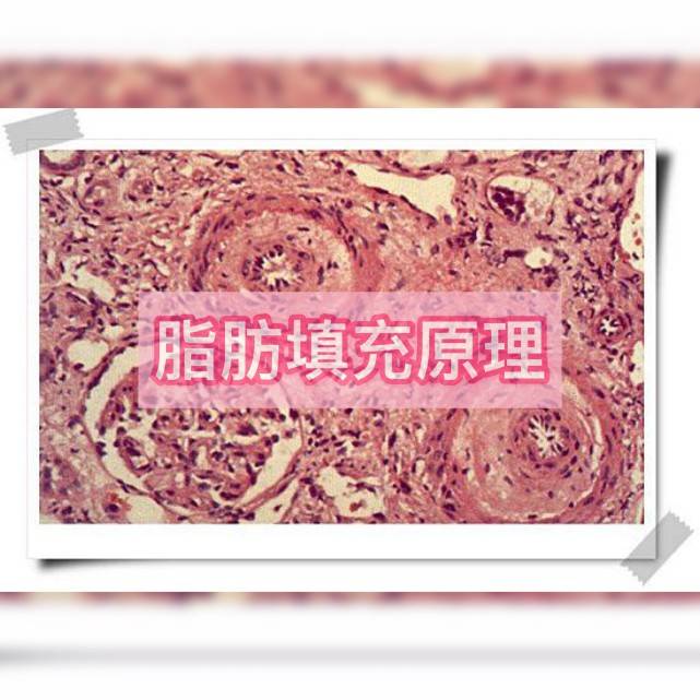 永久|脂肪填充是永久的吗?说可以永久保持是骗人的吗?隔壁阿姨越老越有气质