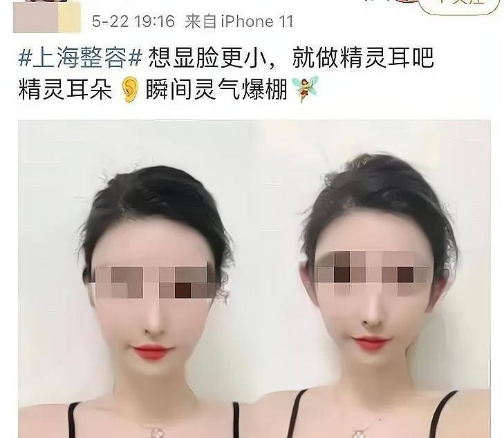 生命|33 岁网红抽脂手术感染去世:“为了变美,我献出了生命”