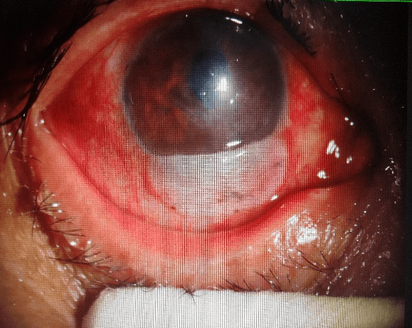 患者|【爱眼护眼77】眼睛里进了异物怎么办