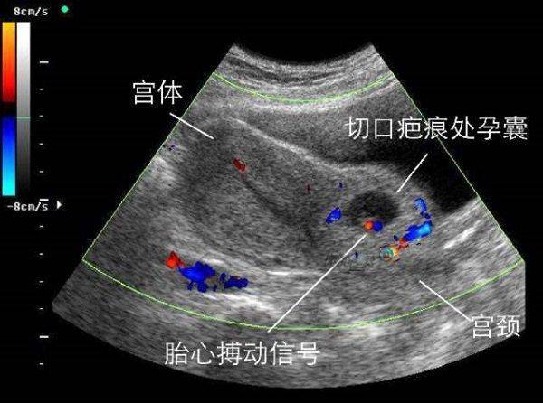 因为|剖腹产没半年又怀孕，孕30周后子宫破裂，大人保住了孩子却没了