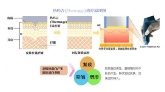 玛吉|专家讲解：做一次热玛吉多少费用？传闻中的电波拉皮仪介绍！