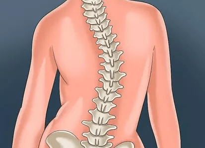 程度|脊柱侧弯危害多，100个人就有3个中招！教你一招来判断