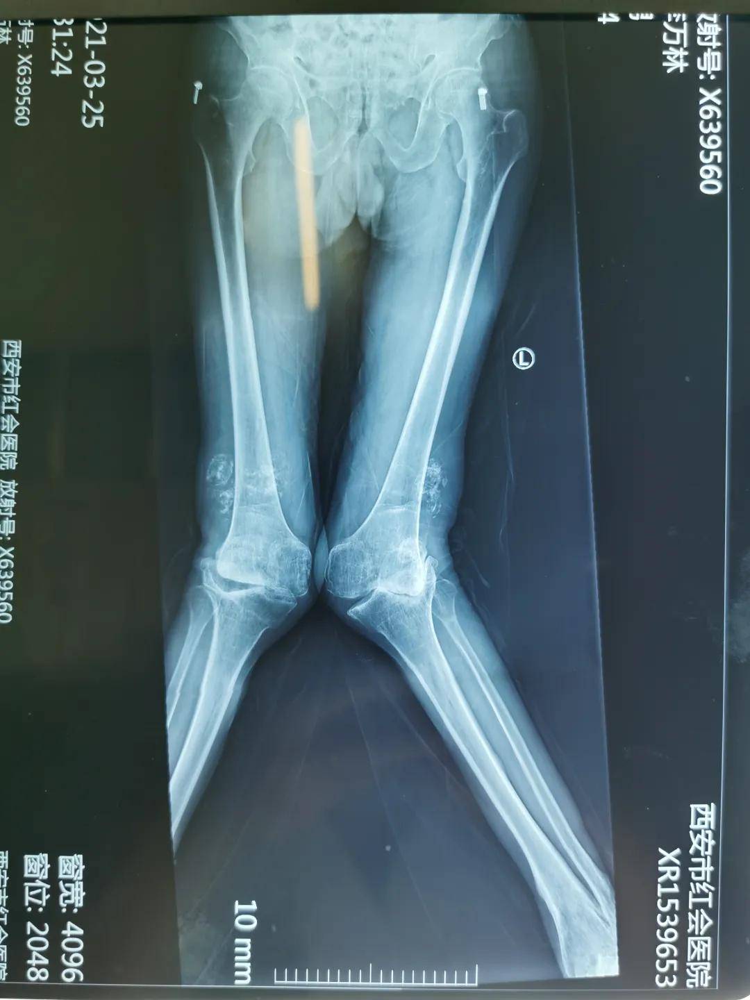 手术|西安市红会医院阎良院区双膝关节置换术圆了甘肃患者“行走梦”