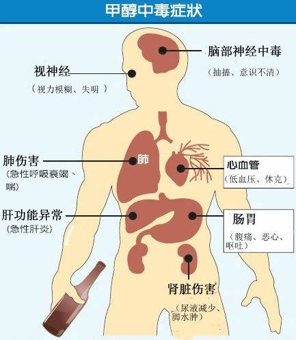 原创假酒害人28岁小伙喝酒致双目失明假酒中毒为何要用真酒解毒