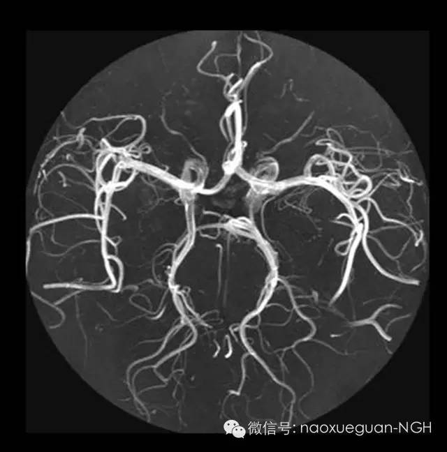 诊断|颅内动脉瘤的检出，主要通过什么方式？