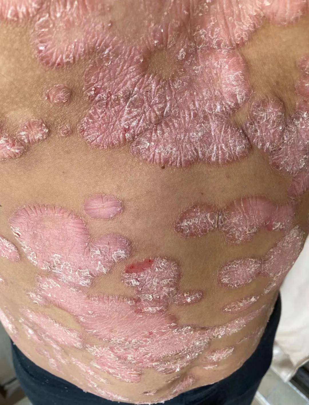 李文思医师治反复难愈的牛皮癣肤质焕新