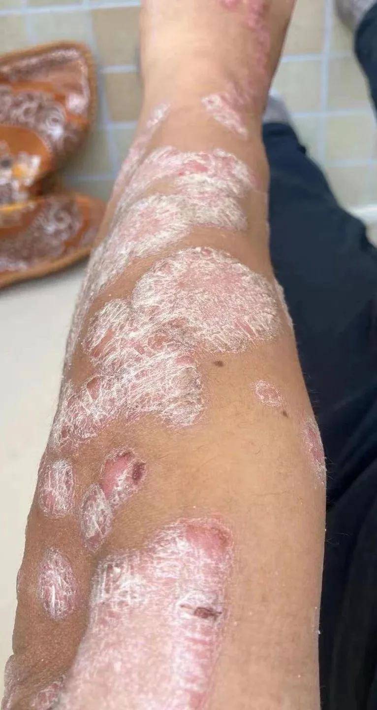 李文思医师治反复难愈的牛皮癣肤质焕新