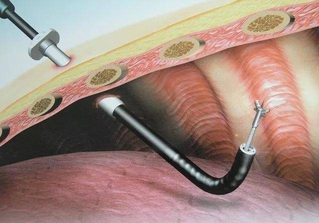 胸膜|“神探”内科胸腔镜