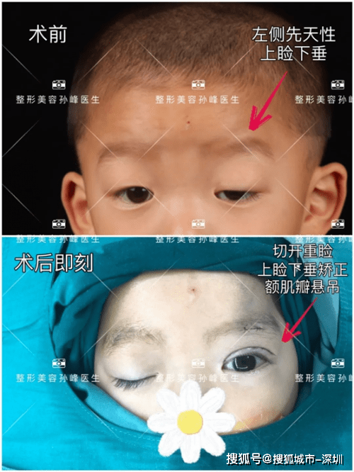 医学|西安国际医学孙峰医生《女友杂志》专访,带你揭秘眼睛变漂亮的秘密