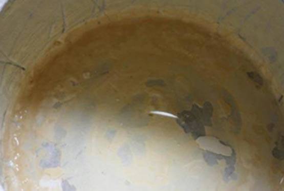 转氨酶|夏季肾结石高发，8个报警信号你收到了吗？