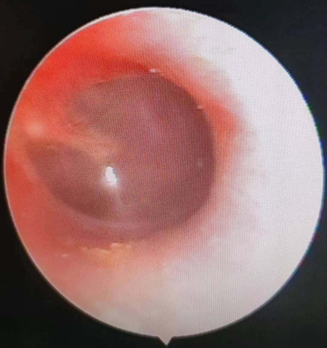 炎症|7岁男孩耳朵剧痛，竟跟游泳有关？