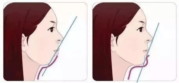 下巴|牙齿各种症状都很需要做牙齿矫正的有哪些