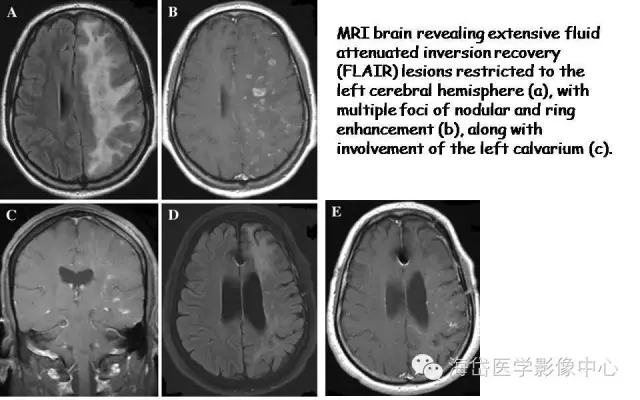 中枢神经系统血管炎_诊断