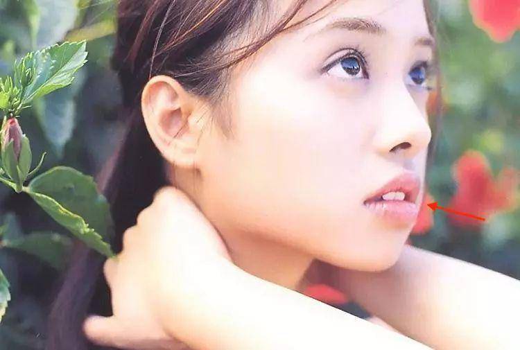 龅牙|广东省全民爱牙行动 地包天需要正畸正颌联合治疗