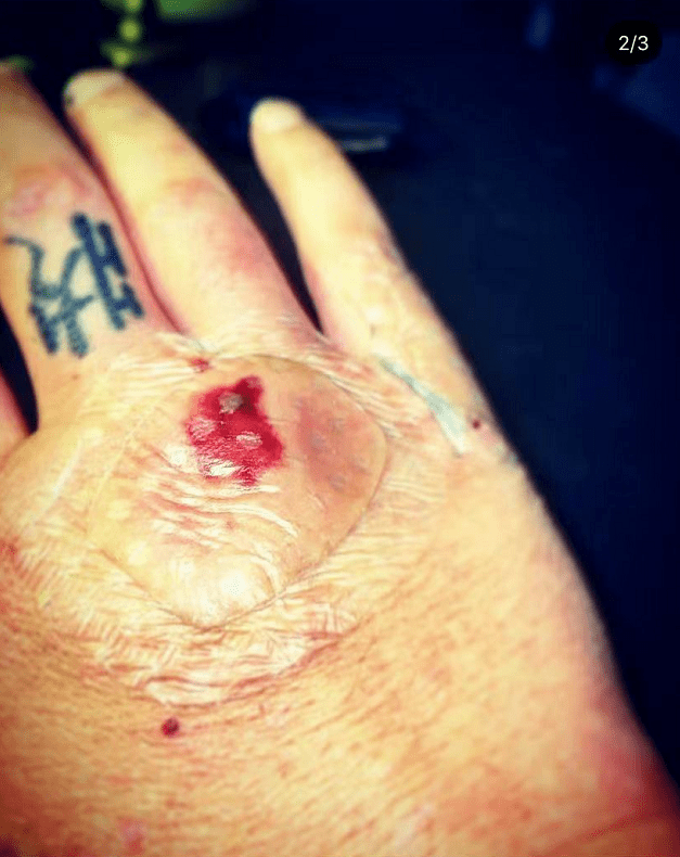 照片中,曹格被狗狗咬伤的伤口清晰可见,即便伤口已经被包扎,但仍有