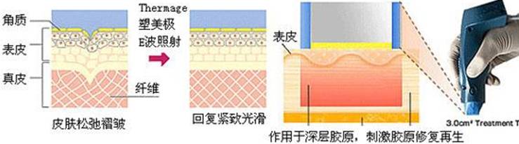 玛吉|扒一扒：热玛吉和热拉提哪个效果好？有没有副作用？