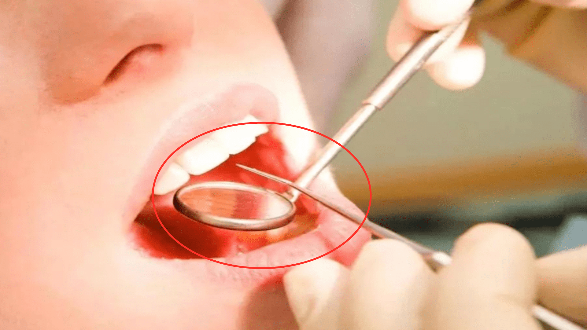 风险|5岁孩子拔牙后脑死亡，拔牙前有注意事项，不仅是张大嘴巴