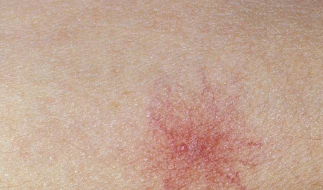 什么|误认为皮肤过敏,结果查出肝癌!提醒:皮肤4种异常或是肝癌前兆