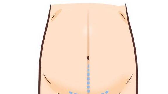 进行|剖腹产横切和竖切,原来是有区别的,想要二胎的宝妈要慎重选择!