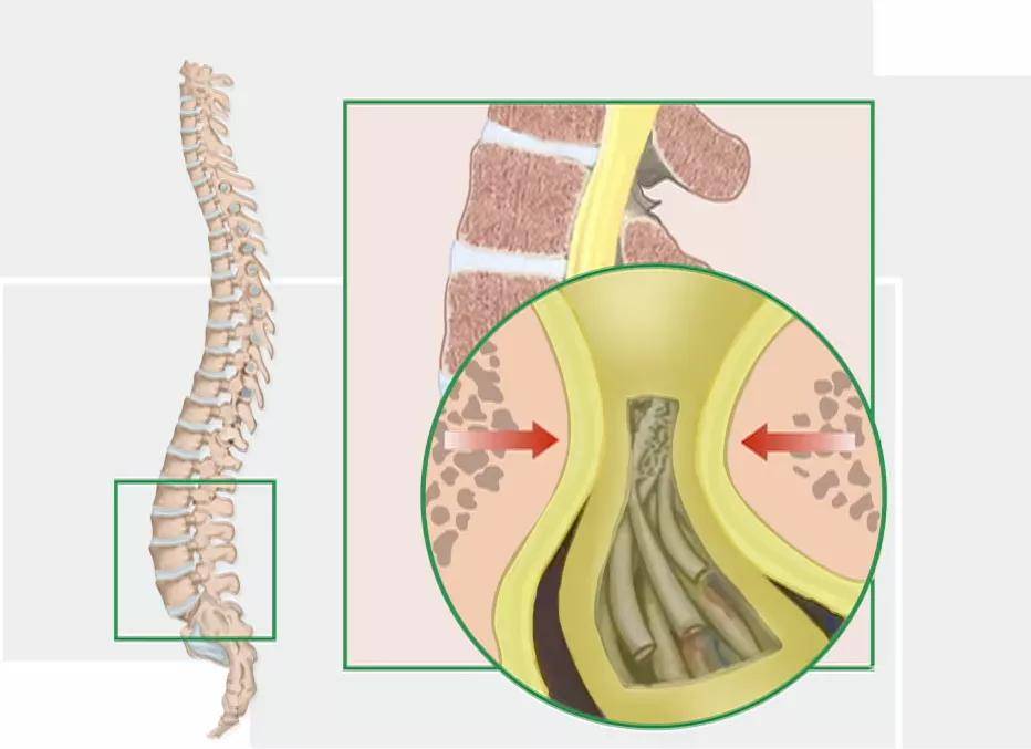 孔镜|76岁大妈经常“走走停停” 专家：当心腰椎管“缩水”