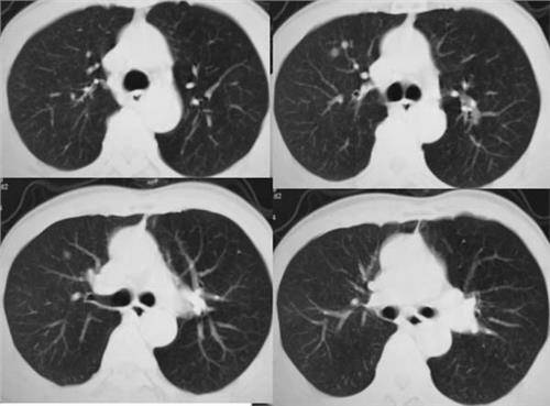 肺癌的照片图片