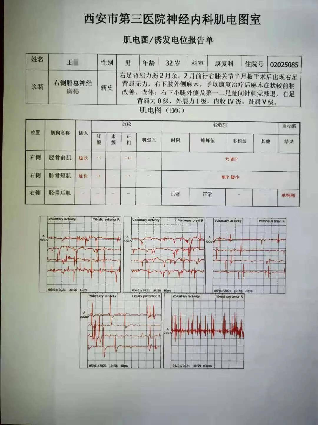 运动|康复治疗︱让腓总神经损伤患者恢复运动功能