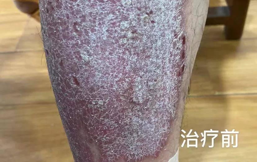 【案例分享】皮炎老反复?中医敷疗让你清爽过夏天!_董医生