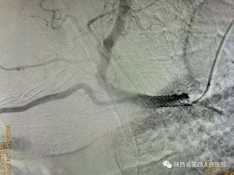 首例|陕西省第四人民医院神经内科完成首例锁骨下动脉闭塞再通术