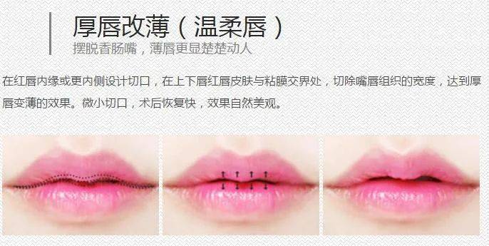 调整|嘟嘟唇、水光唇，告别盲目跟风，唇部可做医美大合集~