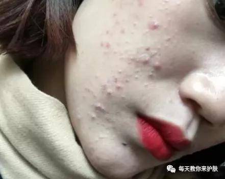 Father's|毛孔粗大，痘痘 可不止爱出油那么简单