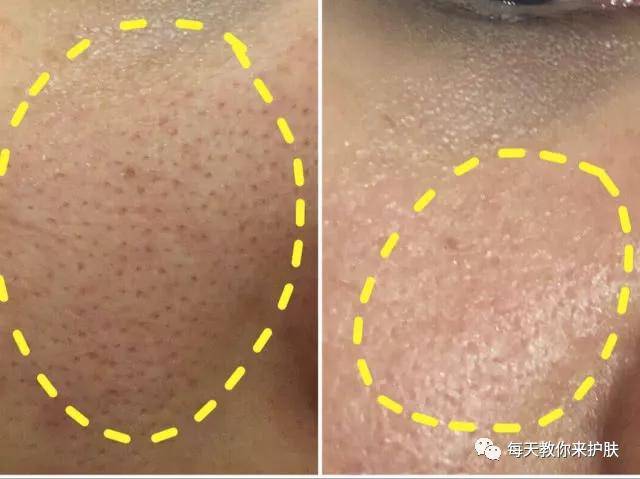 Father's|毛孔粗大，痘痘 可不止爱出油那么简单