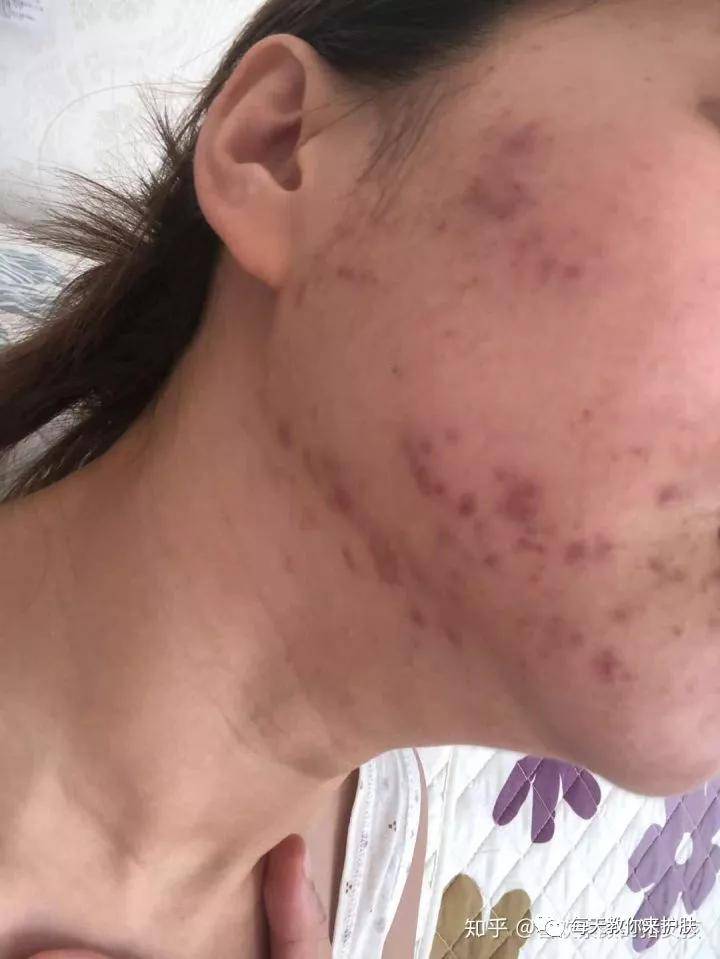 Father's|毛孔粗大，痘痘 可不止爱出油那么简单