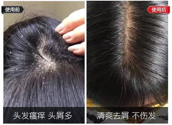 头发|别人脱单你脱发？秃头？油头？你真的应该怪洗发水！