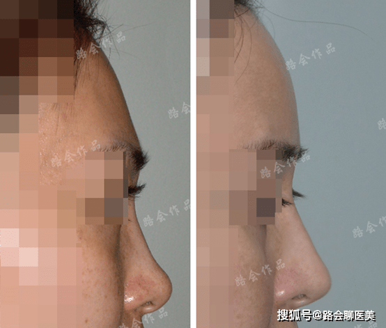 因为|面部凹陷填充可以选择假体吗？